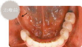 治療前