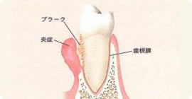 歯周病の進行図
