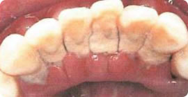 歯石もこうなるとブラッシングでは取れません